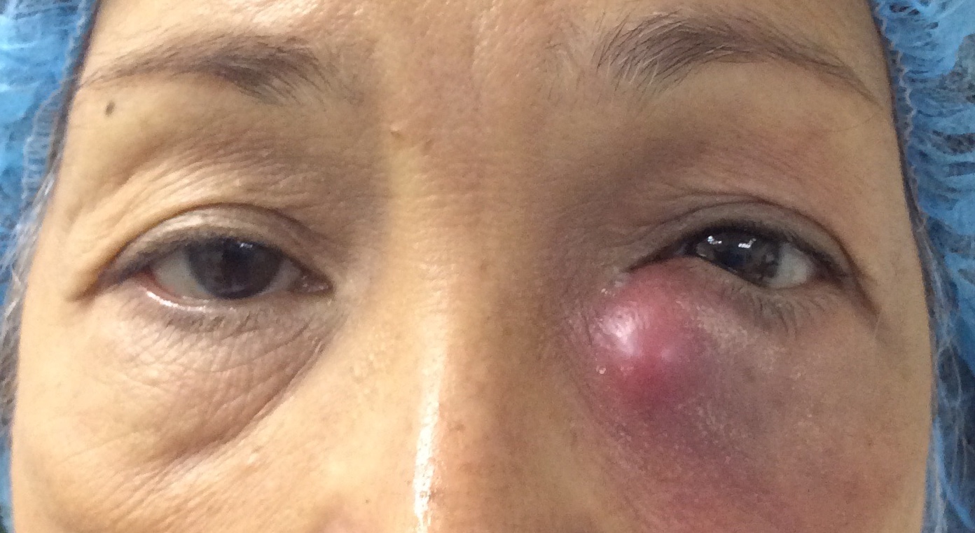 Lacrimal (Tear Duct) Surgery